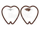 健康な歯と虫歯